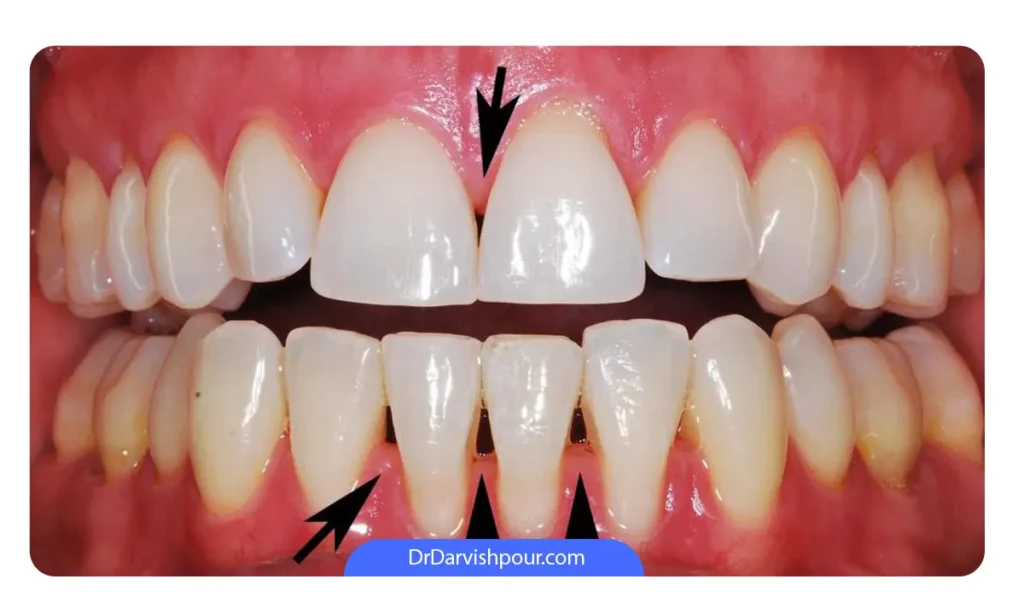 ایجاد فاصله به دلیل جرم های دندانی