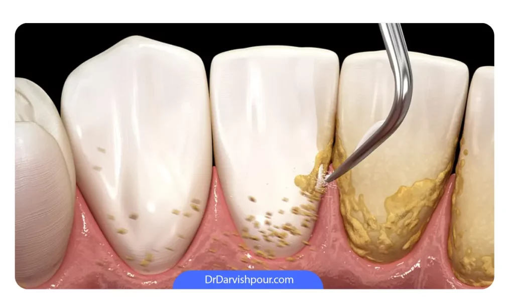 انجام جرمگیری قبل از ارتودنسی دندان