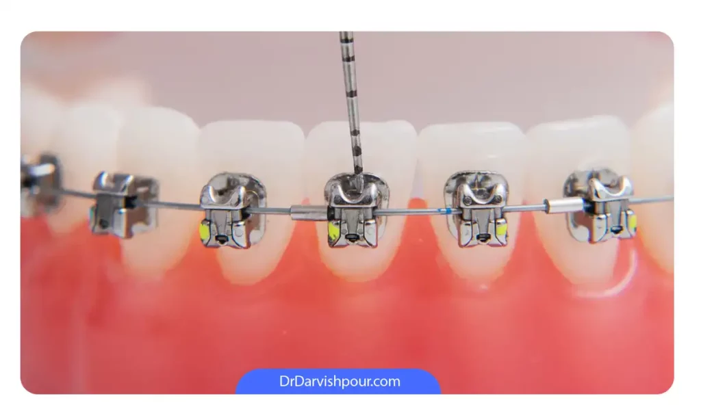 عکس براکت های نصب شده روی ماکت دندانی