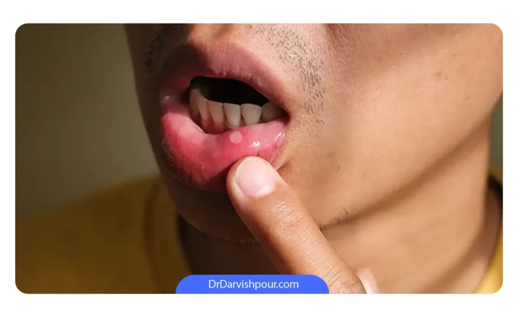 عکس زخم آفت دهان در یک نوجوان پسر
