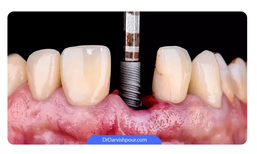 مراحل کاشت یک ایمپلنت دندان