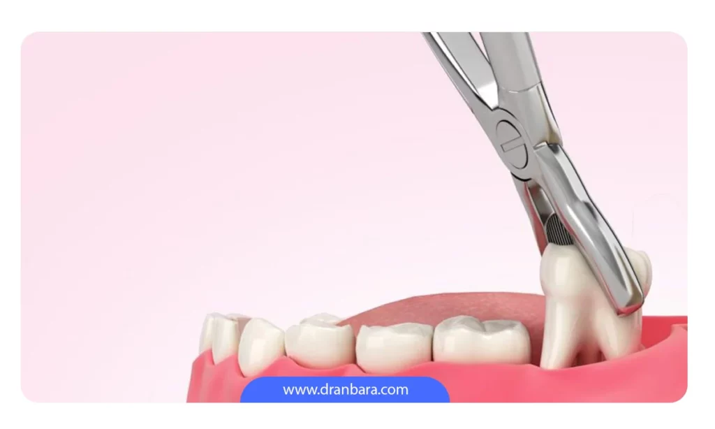 تصویر شماتیک کشیدن دندان عقل