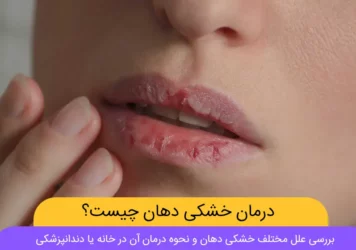 خشکی دهان