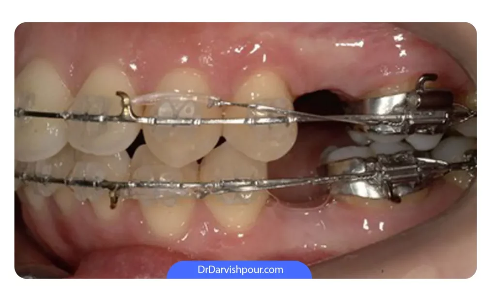 کشیدن دندان سالم برای ارتودنسی