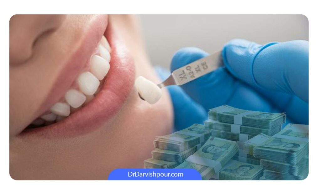 روش های کاهش هزینه لمینت دندان