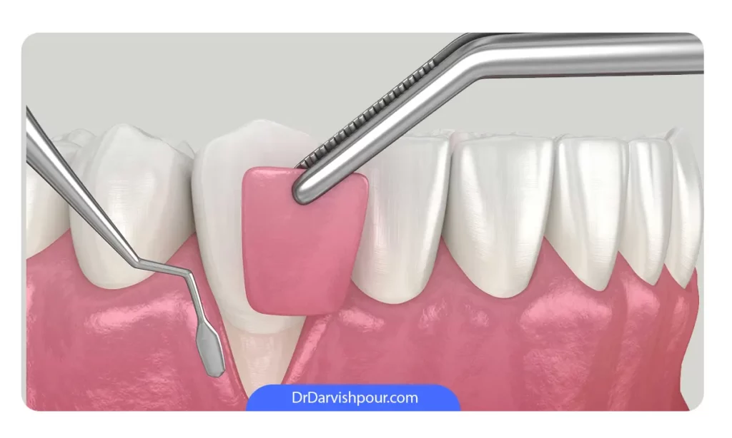 عمل جراحی پیوند لثه برای درمان بیماری لثه