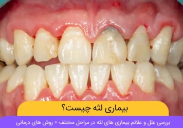 بیماری لثه عکس