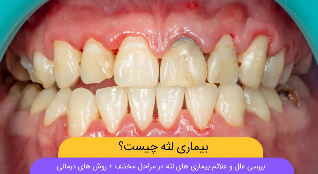 بیماری لثه عکس