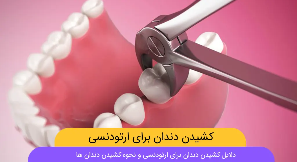 کشیدن دندان برای ارتودنسی