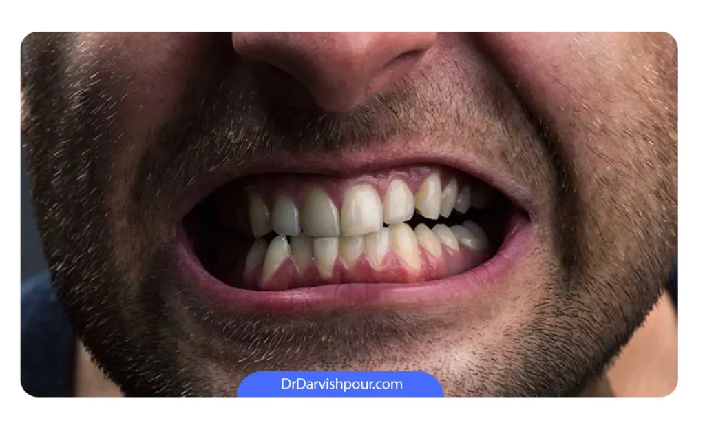 دندان قروچه و حساسیت دندان