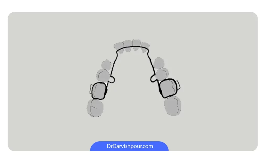 عکس Lingual holding arch