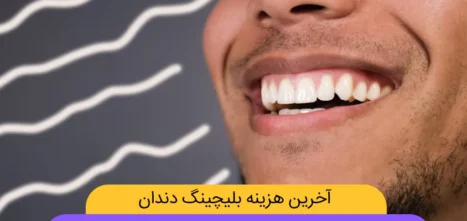 هزینه بلیچینگ دندان در سال