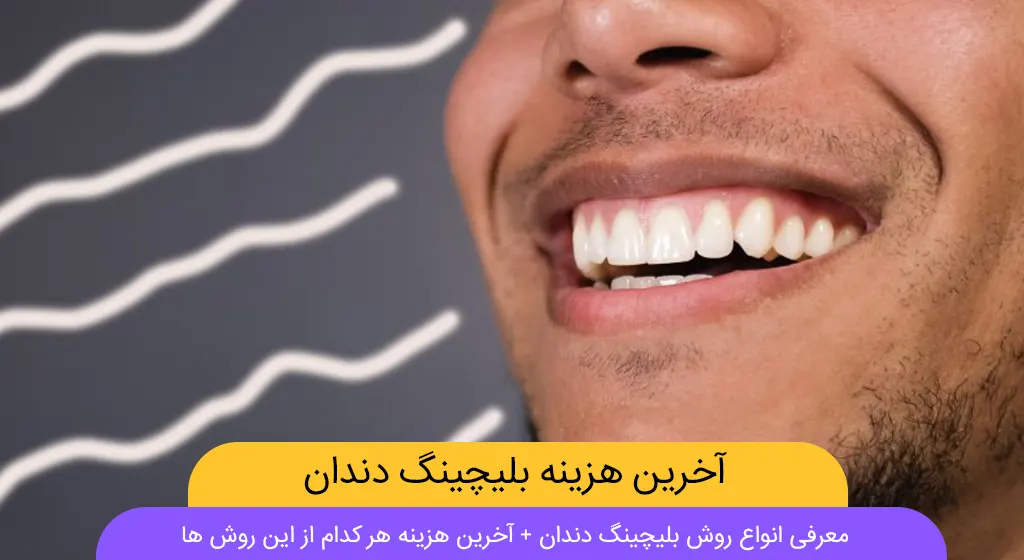 هزینه بلیچینگ دندان در سال