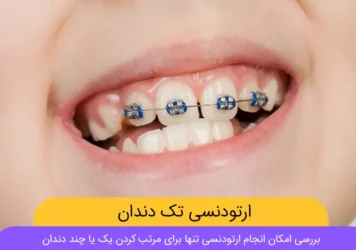 ارتودنسی تک دندان عکس