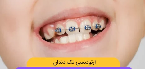 ارتودنسی تک دندان عکس