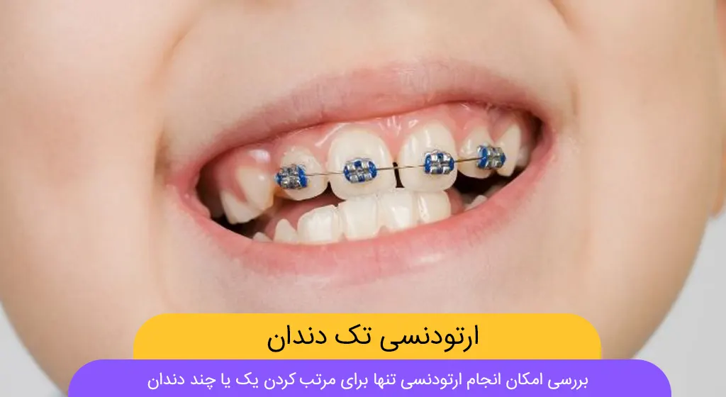 ارتودنسی تک دندان عکس