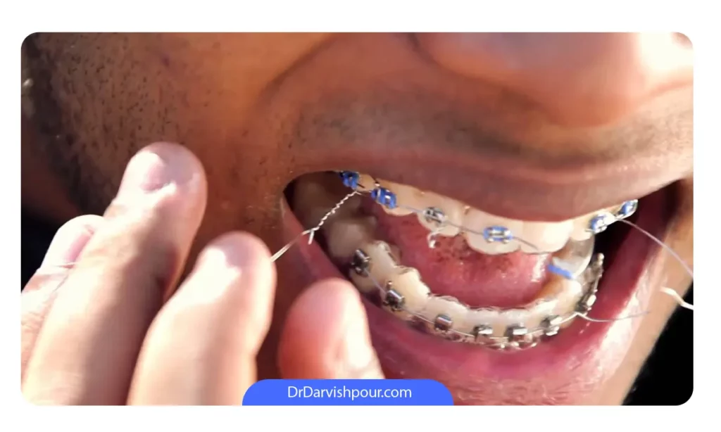 پاره شدن سیم ارتودنسی