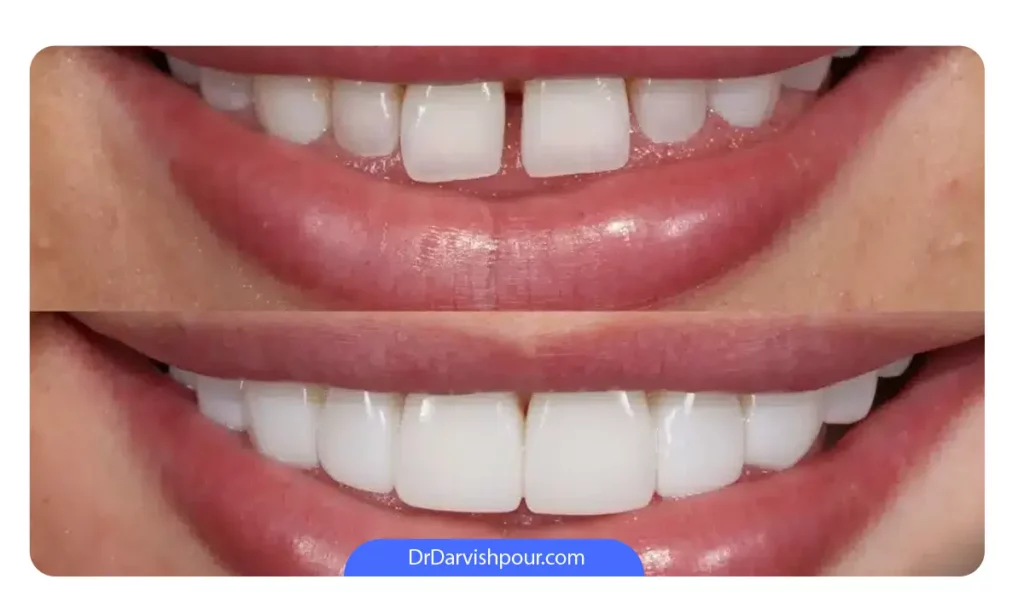 عکس قبل و بعد از کامپوزیت دندان ها جلو