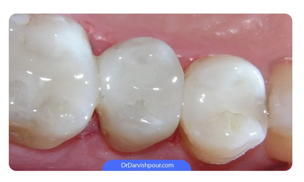 ترمیم دندان