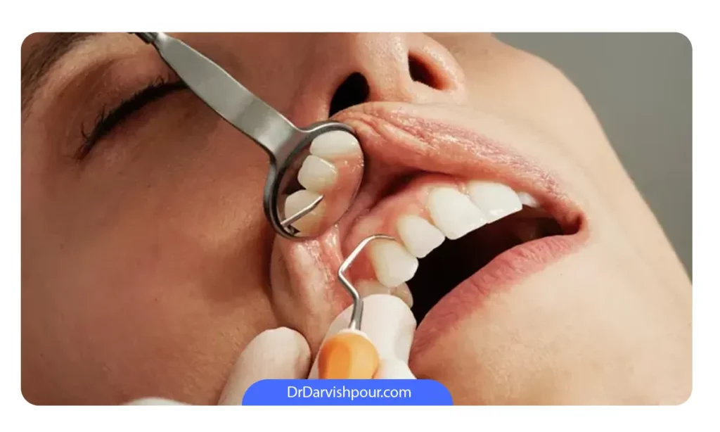 جرمگیری دندان برای درمان ورم لثه