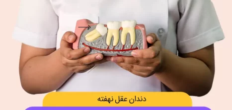 دندان عقل نهفته تصویر شاخص