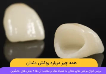 روکش دندان