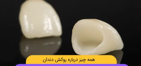 روکش دندان