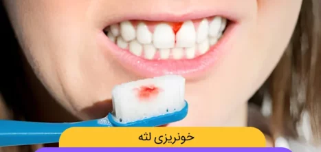 درمان خونریزی لثه