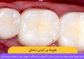 هزینه پر کردن دندان در سال 1403