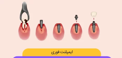 تصویر شاخص ایمپلنت فوری