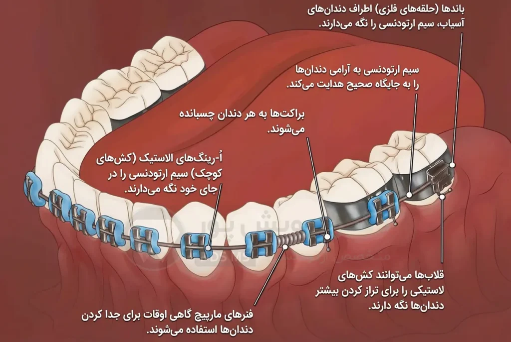 اجزای مختلفبریس ارتودنسی