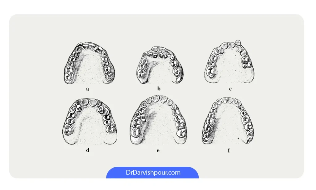 وضعیت های مختلف هایپردنشیا