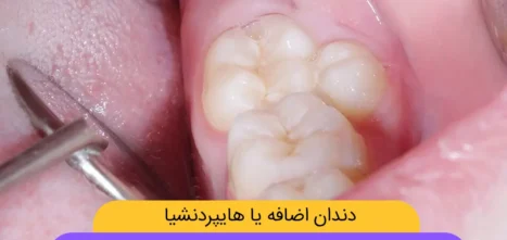 دندان اضافه شاخص