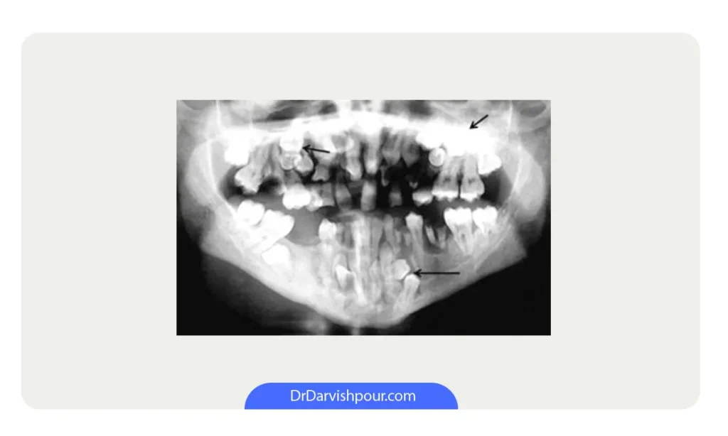 گرافی یک وضعیت هایپردنشیا  شدید