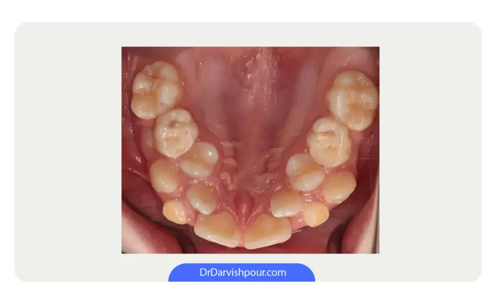 چند دندان اضافه در قوس فکی بالا