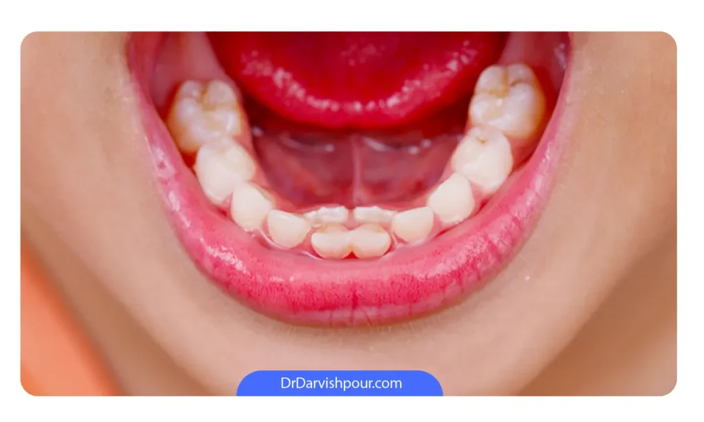 دندان اضافه در فک پایین یک کودک