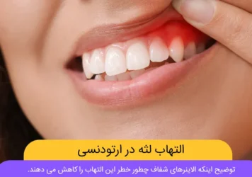 التهاب لثه در ارتودنسی شاخص