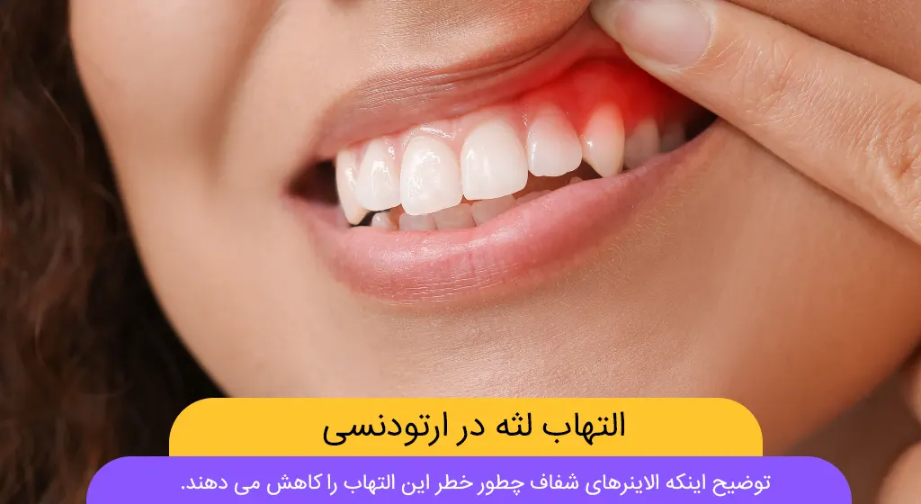 التهاب لثه در ارتودنسی شاخص