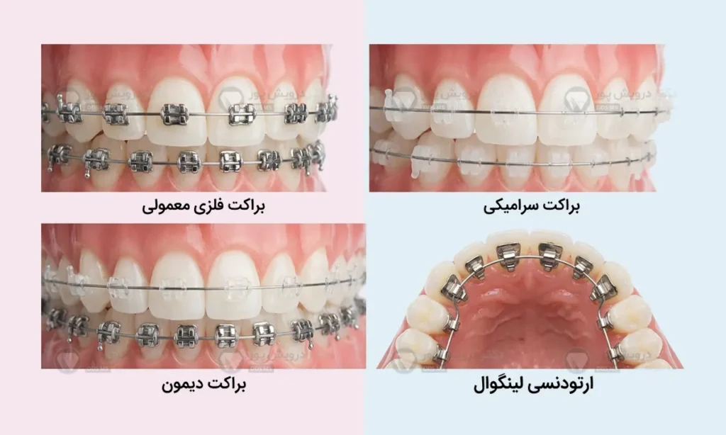 اینفوگرافی انواع براکت ارتودنسی دندان