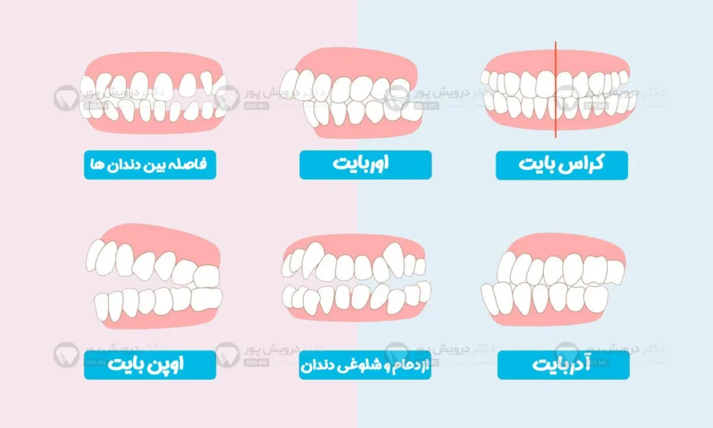 انواع مال اکلوژن