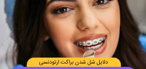 شل شدن براکت های ارتودنسی شاخص