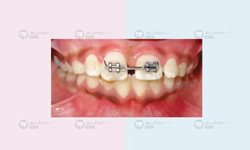 ارتودنسی ثابت برای اصلاح نامرتبی دندان ها