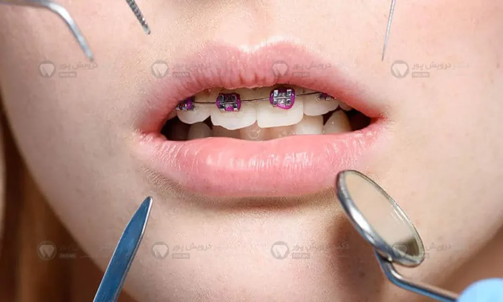 ارتودنسی ثابت