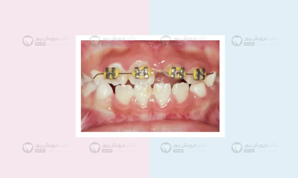 ارتودنسی کودکان برای دندان های فک بالا