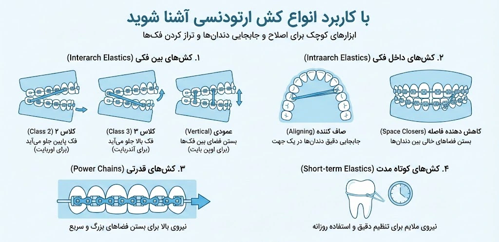 انواع کش ارتودنسی در یک نگاه