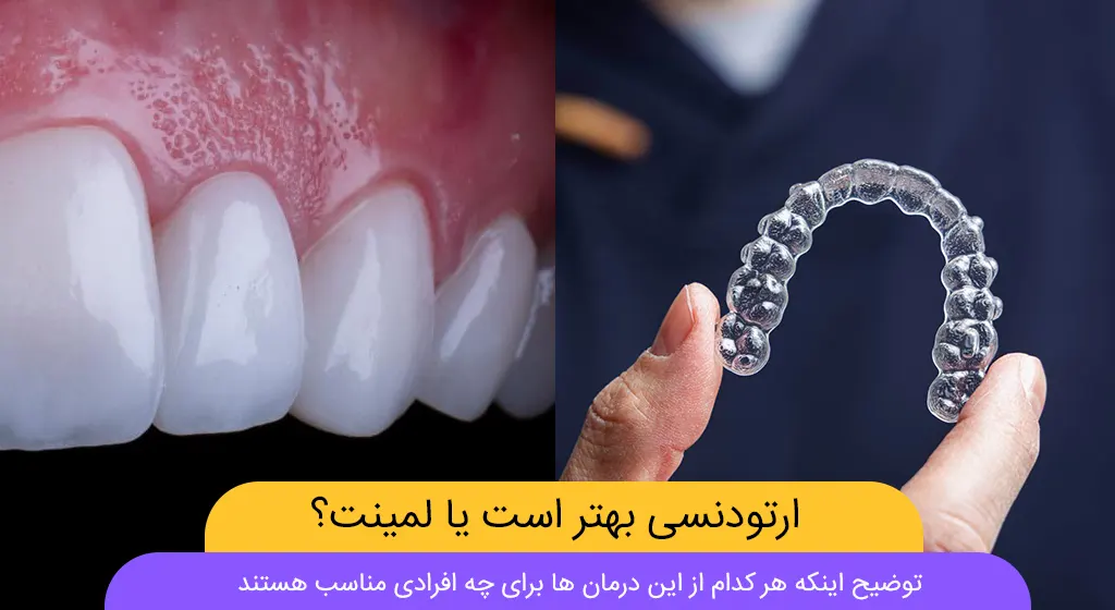 ارتودنسی یا لمینت شاخص