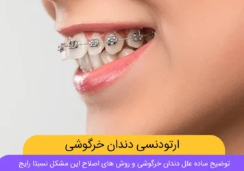 ارتودنسی دندان خرگوشی شاخص