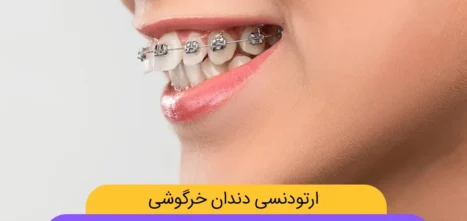 ارتودنسی دندان خرگوشی شاخص