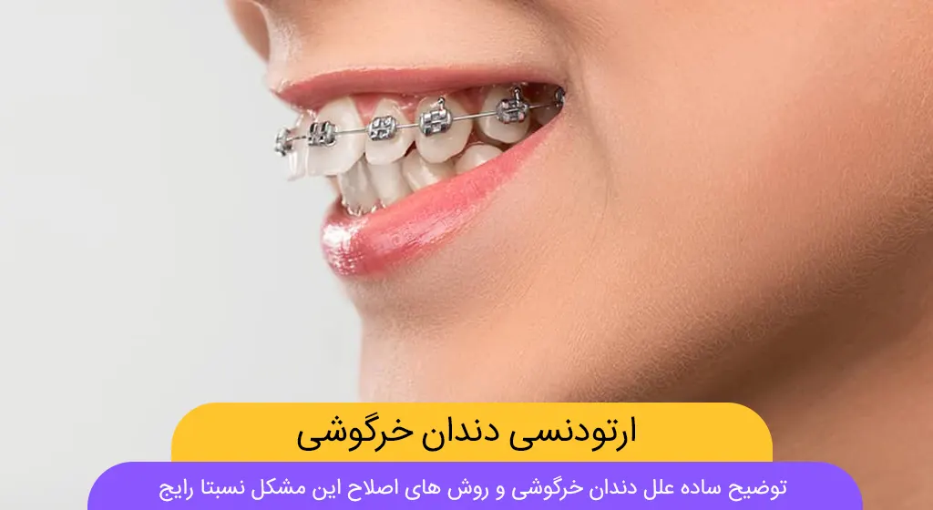 ارتودنسی دندان خرگوشی شاخص
