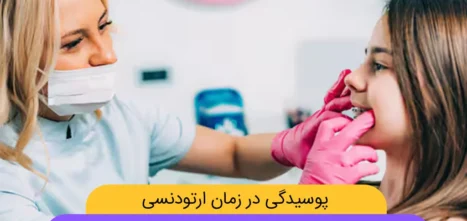 پوسیدگی دندان حین درمان ارتودنسی شاخص